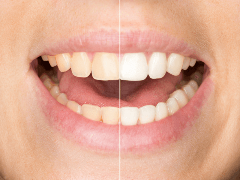 Sử dụng baking soda để vệ sinh răng miệng